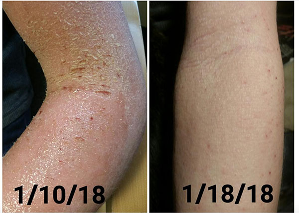 severe eczema better after 1 week