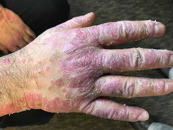 Psoriasis before homeopathy