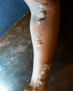 Arm Before Treatment